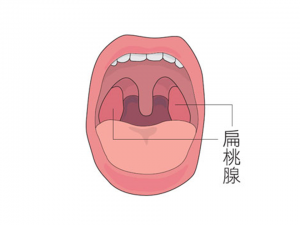 扁桃腺は喉が痛いとき炎症を起こしやすい
